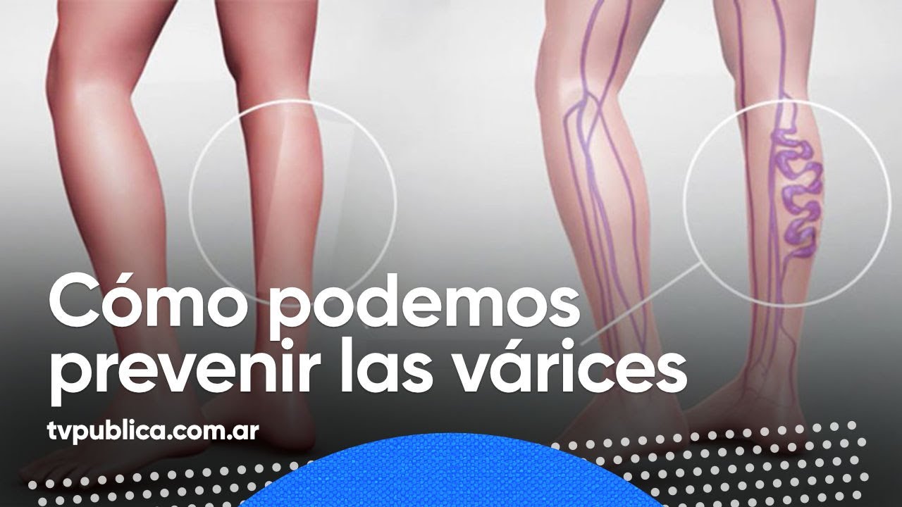 Descubre los alimentos que debes evitar para prevenir las varices