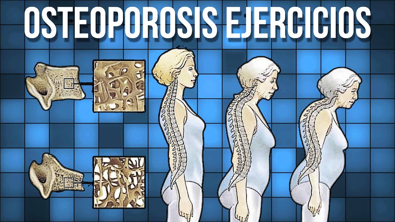 Descubre la tabla de alimentos para combatir la osteoporosis